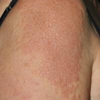 
	Cutaneous sarcoid

	Cutaneous sarcoid presents…