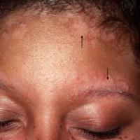 
	Seborrhoeic&nbsp;eczema&nbsp;in darker…