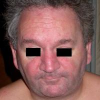 
	Same patient as figure 12
