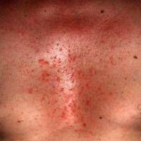 
	Seborrhoeic&nbsp;eczema&nbsp;on the chest