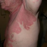 
	Same patient as figure 15

	Sharply marginated