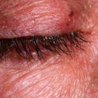 
	Seborrhoeic&nbsp;eczema&nbsp;with…