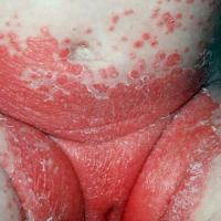 
	Infantile seborrhoeic&nbsp;eczema&nbsp;or…