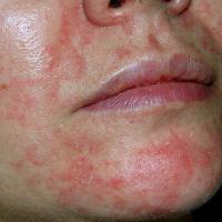 
	Seborrhoeic&nbsp;eczema

	Erythema and fine…