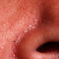 
	Seborrhoeic&nbsp;eczema

	Scale evident (black…