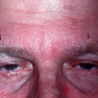 
	Seborrhoeic&nbsp;eczema

	Involvement of…