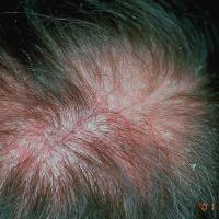 
	Seborrhoeic&nbsp;eczema&nbsp;in the…