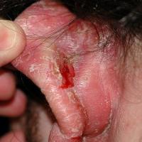 
	Seborrhoeic&nbsp;eczema&nbsp;behind the…