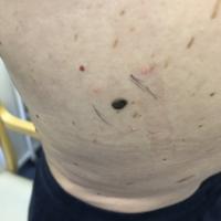 An ugly duckling&nbsp;Seborrhoeic keratoses can…
