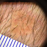 Seborrhoeic keratosis - frogspawn patternCopied…