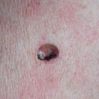 Irritated seborrhoeic keratosisCopied with kind…