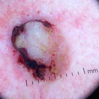 Dermoscopic appearance of previous figureEvidence…