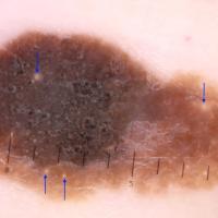 An important lesson - dermoscopy must always be…