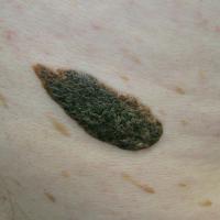 Large seborrhoeic keratosis&nbsp;on the trunkNote…