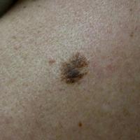Seborrhoeic keratosisThe differential diagnosis…