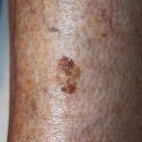 Thin seborrhoeic keratosisCopied with kind…