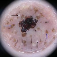Dermoscopic appearance of previous…