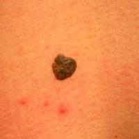Seborrhoeic keratosisThe lesion had a very…