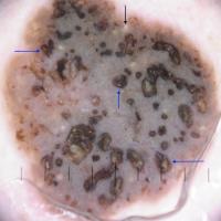 
	Dermoscopic appearance of previous figure…