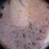 Dermoscopic appearance of previous…