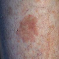 Thin seborrhoeic keratosis on the shinThe lesion…