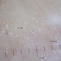 Dermoscopic appearance of previous figureLarge…