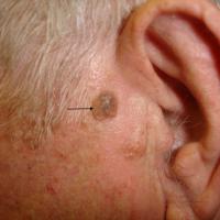 
	Seborrhoeic keratosis left pre-auricular…