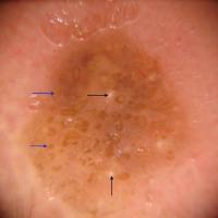 Dermoscopic appearance of previous…