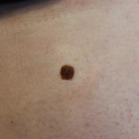 Seborrhoeic keratosis on the backCopied with kind…