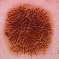 Dermoscopic appearance of previous…
