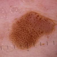 
	Dermoscopic appearance of previous figure…