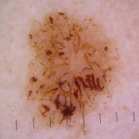 Dermoscopic appearance of previous…