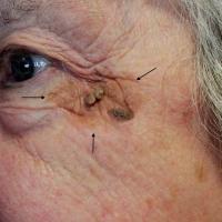 Seborrhoeic keratosis growing on top of a solar…