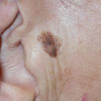Seborrhoeic keratosis right pre-auricularCopied…