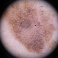 Dermoscopic appearance of previous figureMultiple…