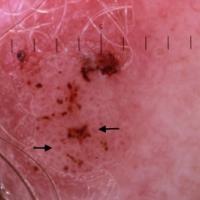 Dermoscopic appearance of previous…