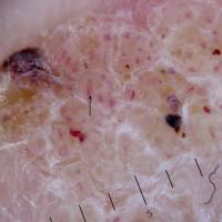 Dermoscopic vascular patterns in seborrhoeic…