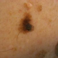 
	Collision tumour
	
	A collision tumour is…