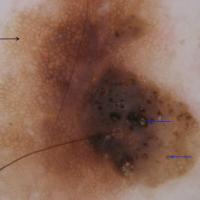 
	Dermoscopic appearance of previous figure…