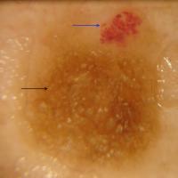 
	Collision tumour - dermoscopic…
