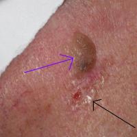 Collision tumourSeborrhoeic keratosis (purple…