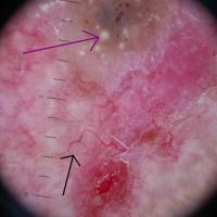 Dermoscopic appearance of previous…