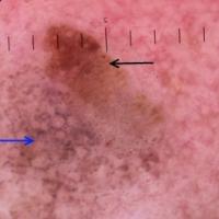 
	Dermoscopic appearance of same lesion

	The…