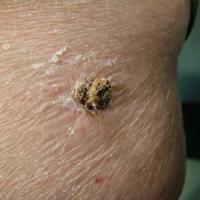 A hyperkeratotic seborrhoeic keratosisA number of…