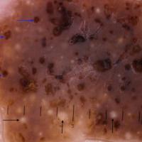 Dermoscopic appearance of previous figure&nbsp;A…