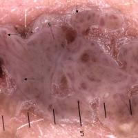 Seborrhoeic keratosis with looped/hairpin…