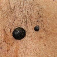 Seborrhoeic keratoses in skin of colourCopied…