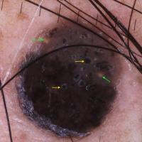 Dermoscopic appearance of the smaller…