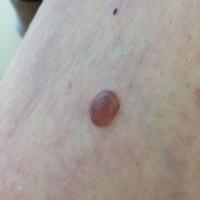 A very pale seborrhoeic keratosis - dermoscopy…