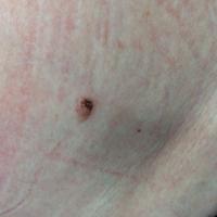 Seborrhoeic keratosis - irritated&nbsp;
If you…